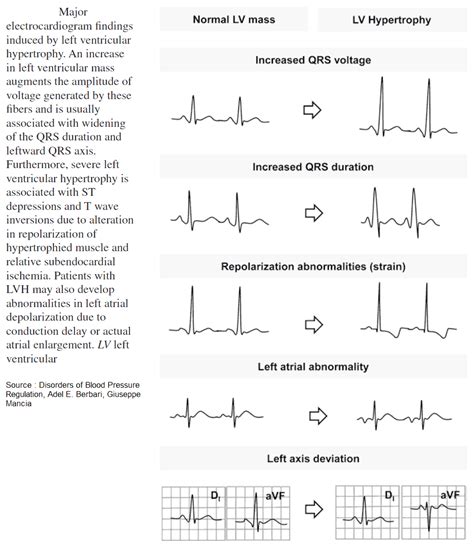 lvh strain|minimum voltage criteria for lvh.